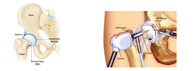 HipArthroscopy1